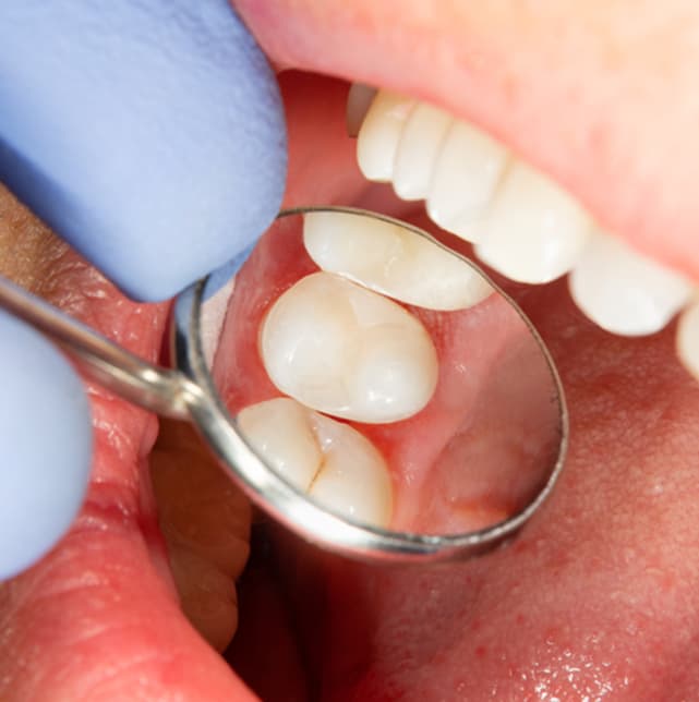 Dental-sealants.jpg